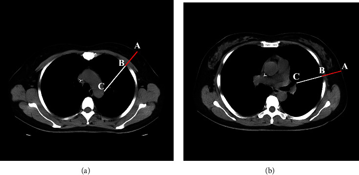 Safety and Risk Factors of Needle Thoracentesis Decompression in Tension Pneumothorax in Patients over 75 Years Old.