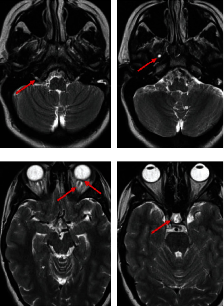 Idiopathic Intracranial Hypertension Papillopathy due to Hormonal Changes during Pregnancy.