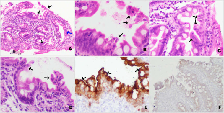 Tufting enteropathy: a rare anatomical cause of small bowel diarrhoea in infants with mild or no villous abnormality.