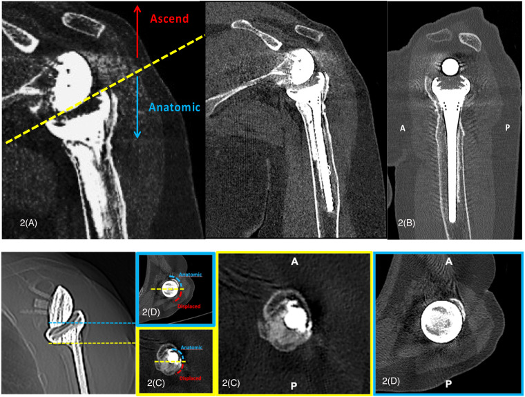 Is the Position and Union of the Tuberosities Assessable by Means of the Simple Radiograph After Reverse Shoulder Arthroplasty for Complex Proximal Humerus Fractures?