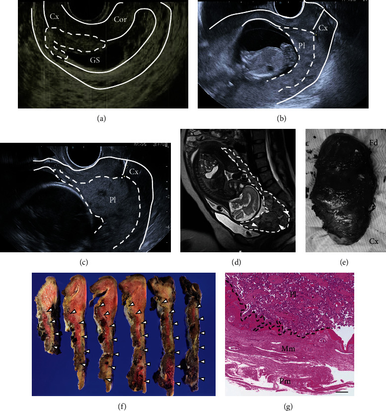 Placental Insertion into the Cervix with Cervical Shortening as a Clinical Sign to Suspect Cervico-Isthmic Pregnancy: A Case Report and Literature Review.