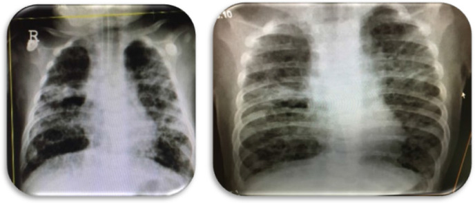 Congenital Skin Rashes in an IVF Baby Progressed to Multisystem Langerhans Cell Histiocytosis with Lung and Bone Involvement: A Case Report and Literature Review.