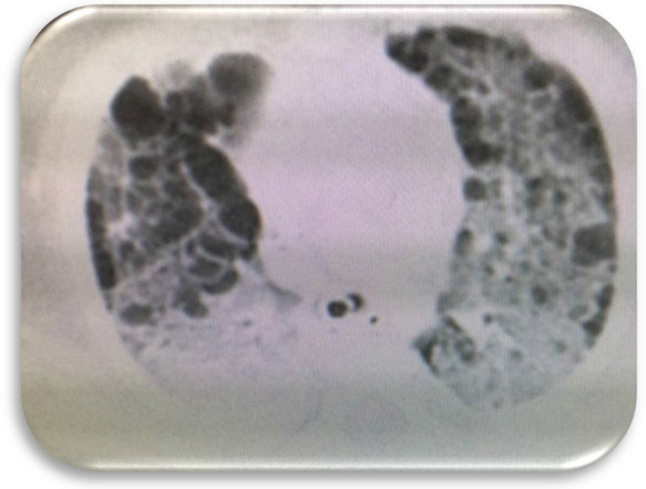 Congenital Skin Rashes in an IVF Baby Progressed to Multisystem Langerhans Cell Histiocytosis with Lung and Bone Involvement: A Case Report and Literature Review.