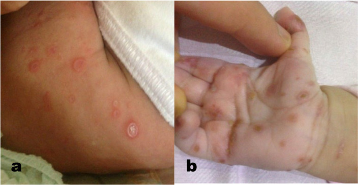 Congenital Skin Rashes in an IVF Baby Progressed to Multisystem Langerhans Cell Histiocytosis with Lung and Bone Involvement: A Case Report and Literature Review.