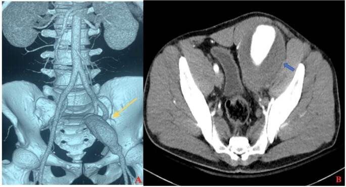 Isolated external iliac artery aneurysm: a rare case presentation of IgG4-related disease.