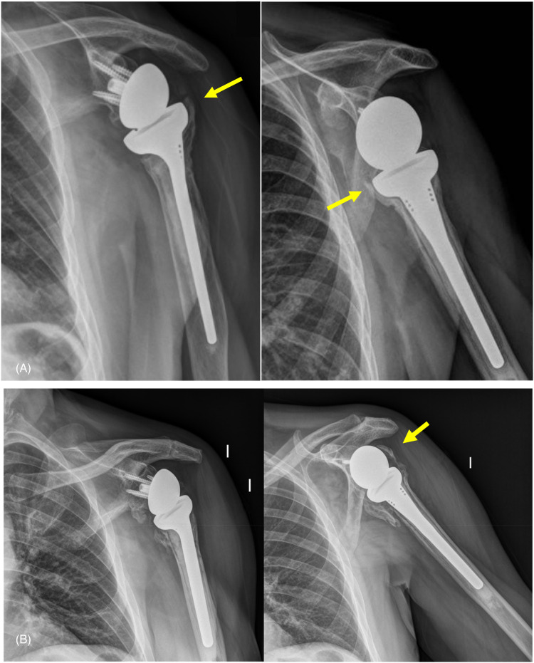 Is the Position and Union of the Tuberosities Assessable by Means of the Simple Radiograph After Reverse Shoulder Arthroplasty for Complex Proximal Humerus Fractures?