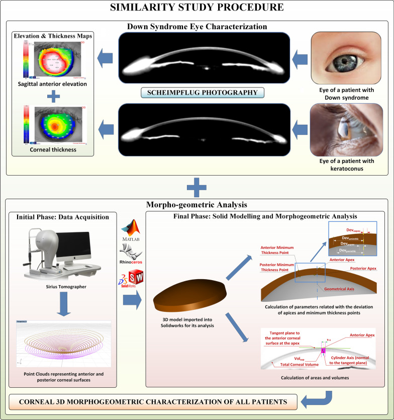 A three-dimensional morpho-volumetric similarity study of Down syndrome keratopathy vs. keratoconus.