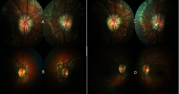 Idiopathic Intracranial Hypertension Papillopathy due to Hormonal Changes during Pregnancy.