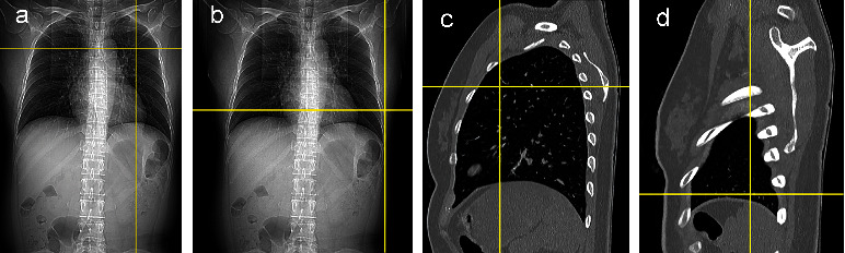 Safety and Risk Factors of Needle Thoracentesis Decompression in Tension Pneumothorax in Patients over 75 Years Old.