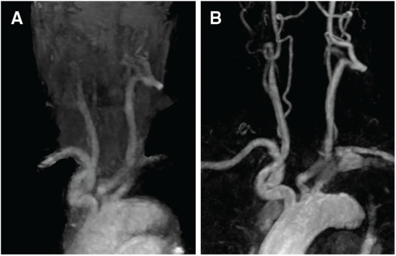 Comparison of Access Route for Endovascular Treatment by Time-Spatial Labeling Inversion Pulse (Time-SLIP) MRA and Contrast-Enhanced MRA.