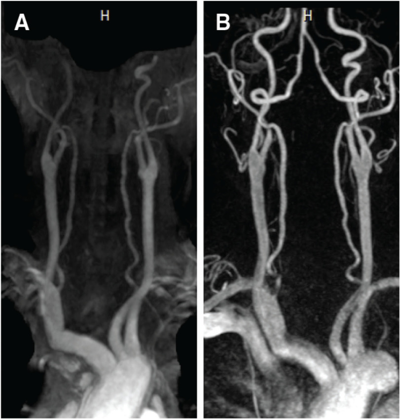 Comparison of Access Route for Endovascular Treatment by Time-Spatial Labeling Inversion Pulse (Time-SLIP) MRA and Contrast-Enhanced MRA.