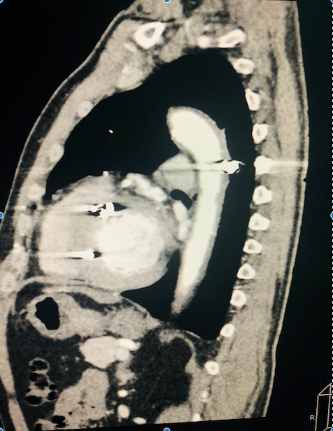 Traumatic aorta injuries in a rural area: late manifestations and review of therapeutic aspects.