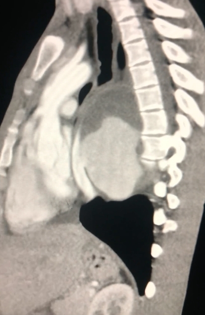 Traumatic aorta injuries in a rural area: late manifestations and review of therapeutic aspects.