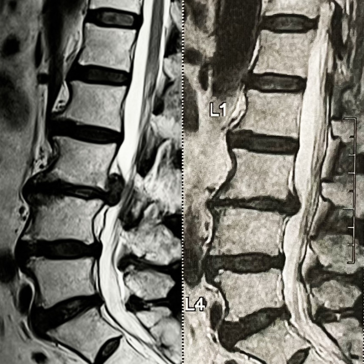 An L2/3 Disc Herniation-Related L5 Radiculopathy.