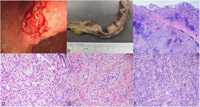 Case report: Gastric adenosquamous carcinoma with EBV-positive component of squamous cell carcinoma mixed with gastric carcinoma with lymphoid stroma: A novel case report and literature review.