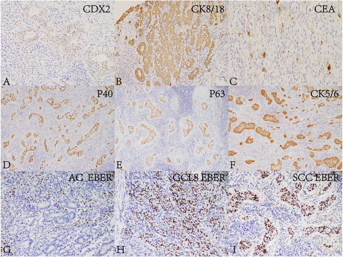 Case report: Gastric adenosquamous carcinoma with EBV-positive component of squamous cell carcinoma mixed with gastric carcinoma with lymphoid stroma: A novel case report and literature review.