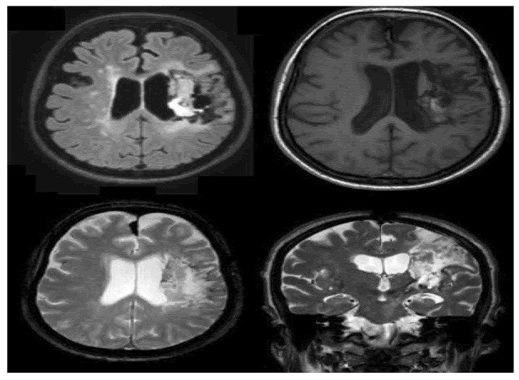 Music Therapy in Global Aphasia: A Case Report.