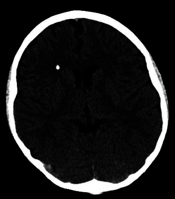 A Giant Parathyroid Adenoma Presenting as Nausea, Vomiting, and Headaches in an Adolescent Male.