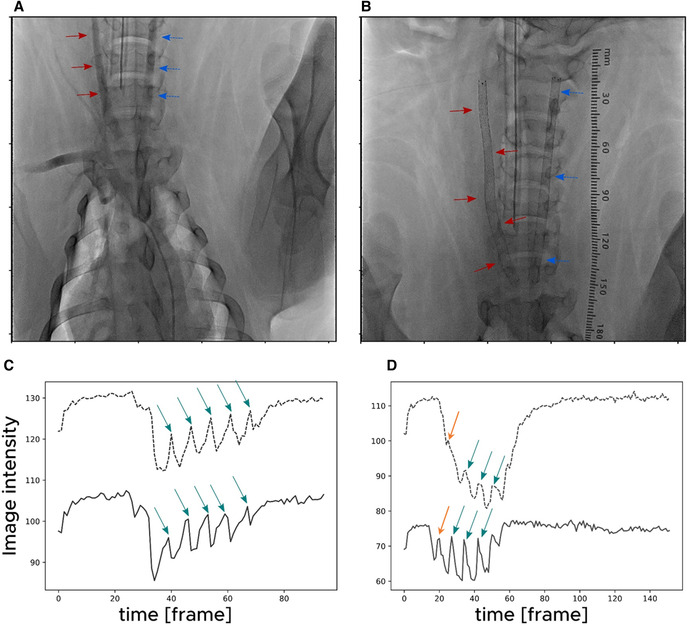 Effects of helical centerline stent vs. straight stent placement on blood flow velocity.