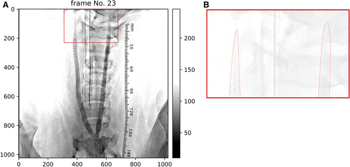 Effects of helical centerline stent vs. straight stent placement on blood flow velocity.