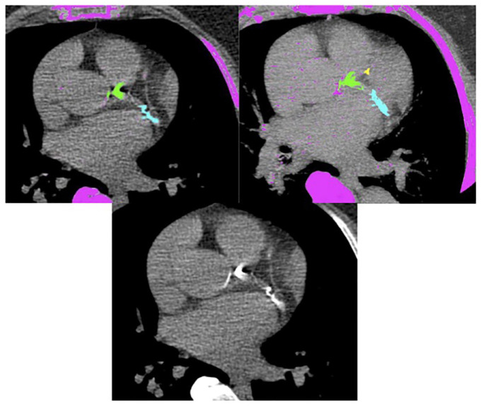 Transient left bundle branch block associated with very high coronary artery calcium: a case report.