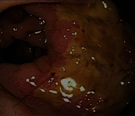 Herpes Proctitis in Men Mimicking Rectal Adenocarcinoma: Two Cases of an Easily Overlooked Diagnosis in the Proximal Rectum.