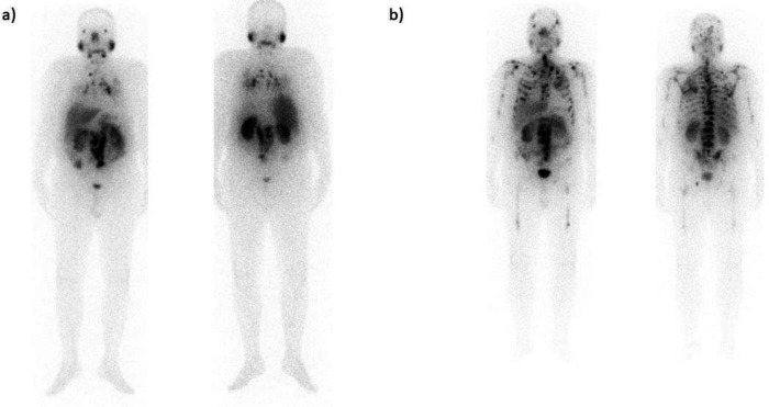 Therapeutic Outcomes of <sup>177</sup>Lu-PSMA Targeted Therapy in Patients with Metastatic Castration-Resistant Prostate Cancer: A Single-Center Study.