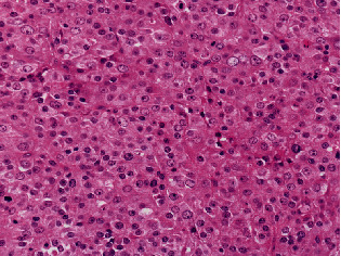 A Case of GATA3 Positive Pleomorphic Liposarcoma, Epithelioid Variant: A Diagnostic Pitfall.