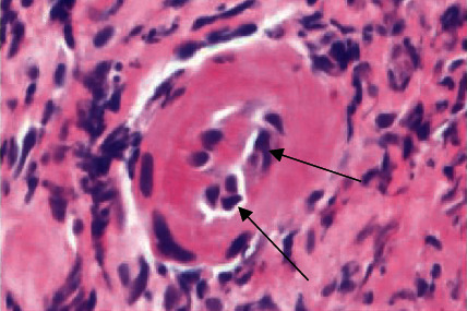 Herpes Proctitis in Men Mimicking Rectal Adenocarcinoma: Two Cases of an Easily Overlooked Diagnosis in the Proximal Rectum.