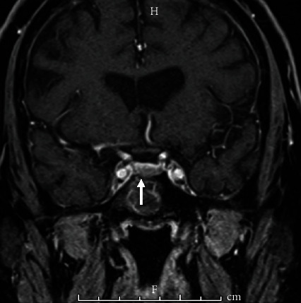 Cushing's Disease Presenting with Functional Neurological (Conversion) Disorder.