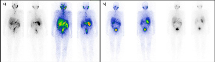 Therapeutic Outcomes of <sup>177</sup>Lu-PSMA Targeted Therapy in Patients with Metastatic Castration-Resistant Prostate Cancer: A Single-Center Study.