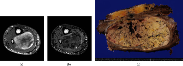 A Case of GATA3 Positive Pleomorphic Liposarcoma, Epithelioid Variant: A Diagnostic Pitfall.