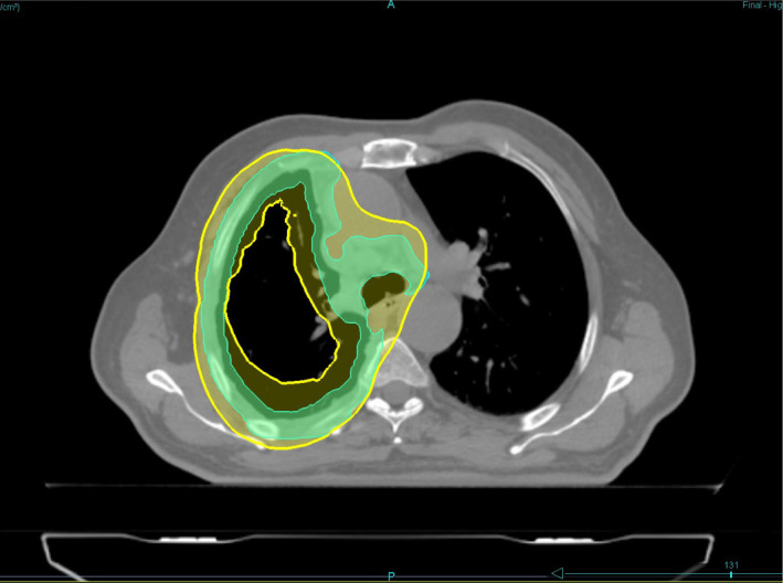 Trimodality therapy of malignant pleural mesothelioma with helical tomotherapy.