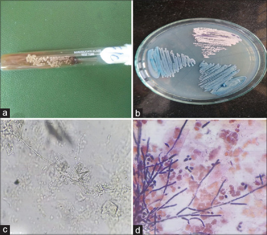 Clinicoetiological study on vaginal discharge among sexually active women attending a tertiary center in North Kerala, India.