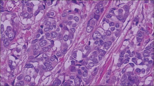 A rare invasive male breast cancer of nonspecific type presenting at a primary care clinic: Importance of early diagnosis and management.