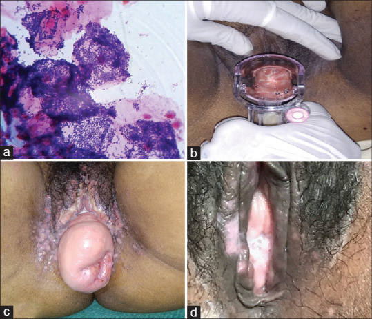 Clinicoetiological study on vaginal discharge among sexually active women attending a tertiary center in North Kerala, India.