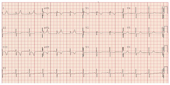 Transient left bundle branch block associated with very high coronary artery calcium: a case report.