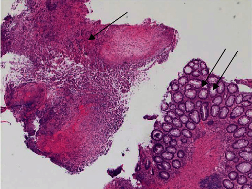 Herpes Proctitis in Men Mimicking Rectal Adenocarcinoma: Two Cases of an Easily Overlooked Diagnosis in the Proximal Rectum.