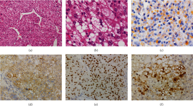 A Case of GATA3 Positive Pleomorphic Liposarcoma, Epithelioid Variant: A Diagnostic Pitfall.