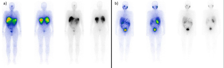 Therapeutic Outcomes of <sup>177</sup>Lu-PSMA Targeted Therapy in Patients with Metastatic Castration-Resistant Prostate Cancer: A Single-Center Study.