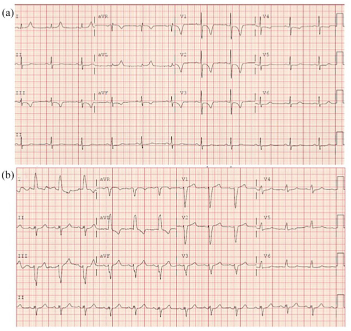 Transient left bundle branch block associated with very high coronary artery calcium: a case report.