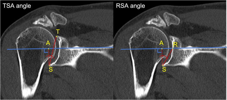 The Reverse Shoulder Arthroplasty Angle in MRI: Impact of the Articular Cartilage in the Estimated Inclination of the Inferior Glenoid.