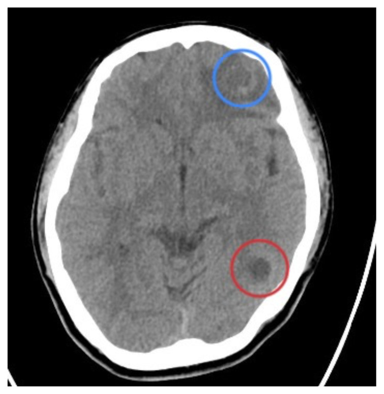 Epilepsy Caused by Neurocysticercosis: A Case Report.