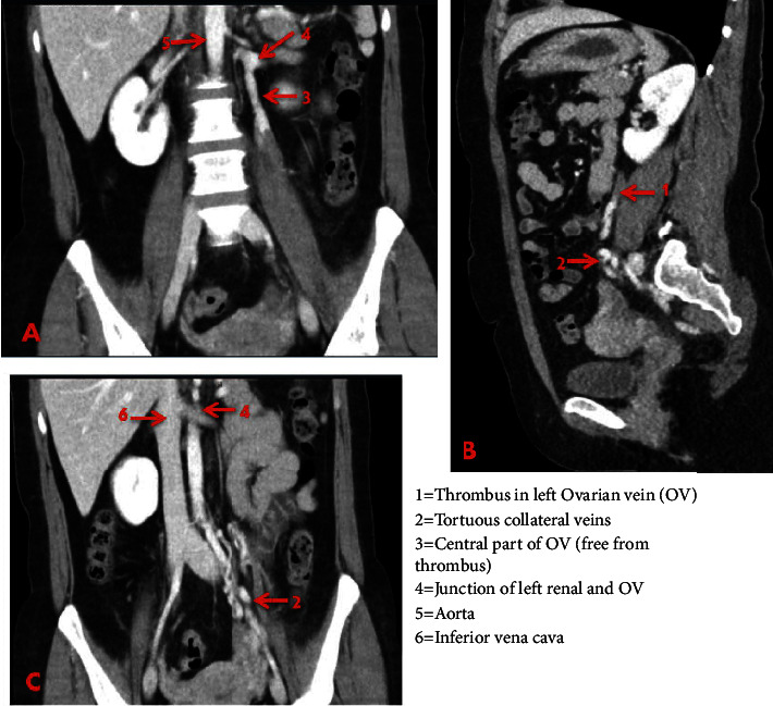 Acute Abdominal Pain as a Result of an Isolated Left Ovarian Vein Thrombosis.