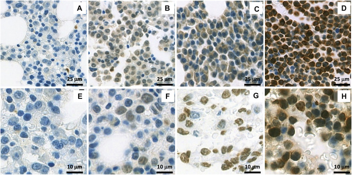 High prevalence of Wilms tumor 1 expression in multiple myeloma and plasmacytoma: A cohort of 142 Asian patients' samples.