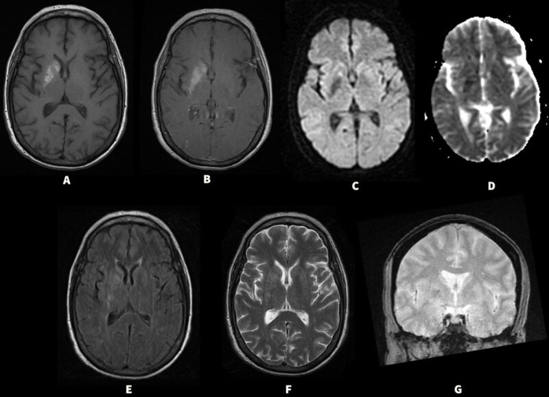 Deep Brain Stimulation for the Treatment of Hemichorea: Case Series and Literature Review.