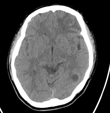 Epilepsy Caused by Neurocysticercosis: A Case Report.