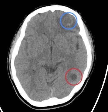 Epilepsy Caused by Neurocysticercosis: A Case Report.