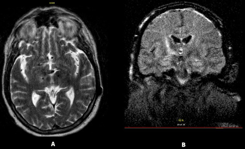 Deep Brain Stimulation for the Treatment of Hemichorea: Case Series and Literature Review.