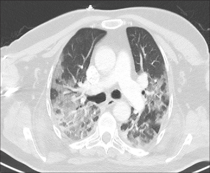 Transient ischemic liver injury and respiratory failure in a COVID-19-positive patient after multiple bee stings.